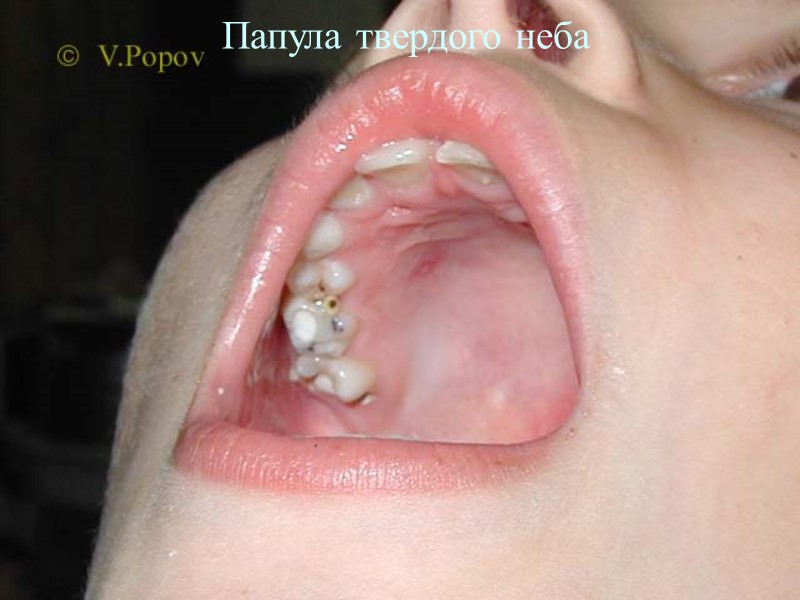 Папула твердого неба